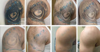 Vascular / Birthmark Q Switched ND Yag Laser Tattoo Removal Machine 5Hz Virtually painless